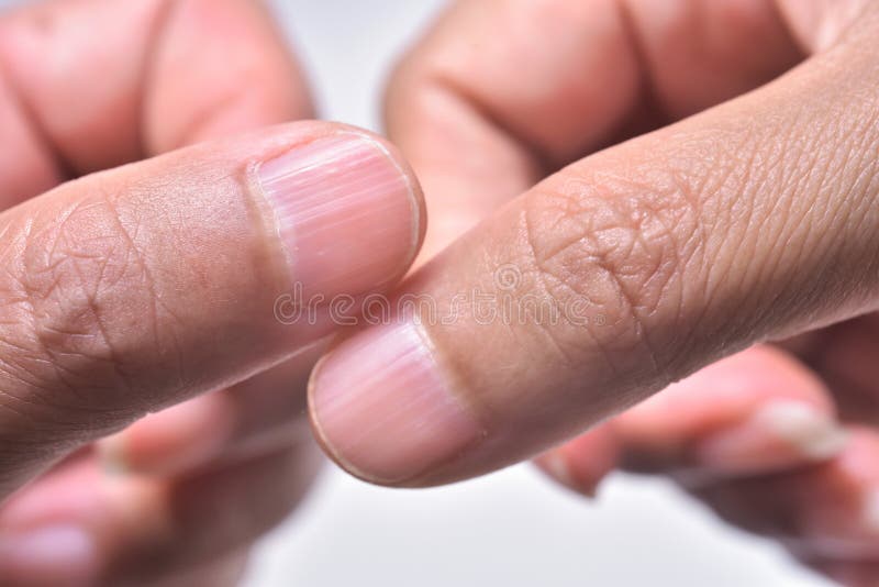 vertical lines on nails