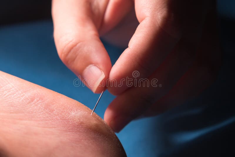 Los Dedos De Las Mujeres Usan Aguja Para Perforar Un Callo En El Talón Imagen de archivo - Imagen de dedo, seco: 225139275