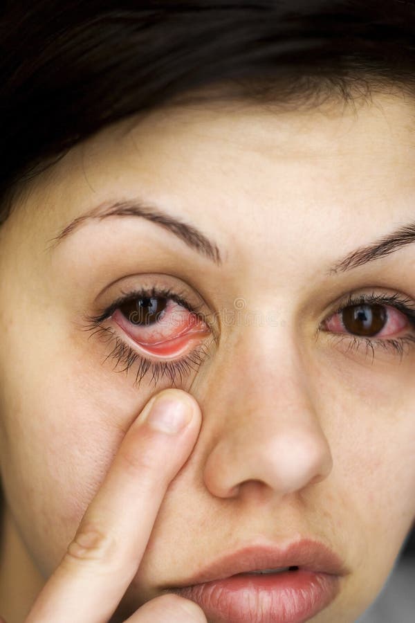  Los Ojos De La Mujer Enferma Imagen de archivo