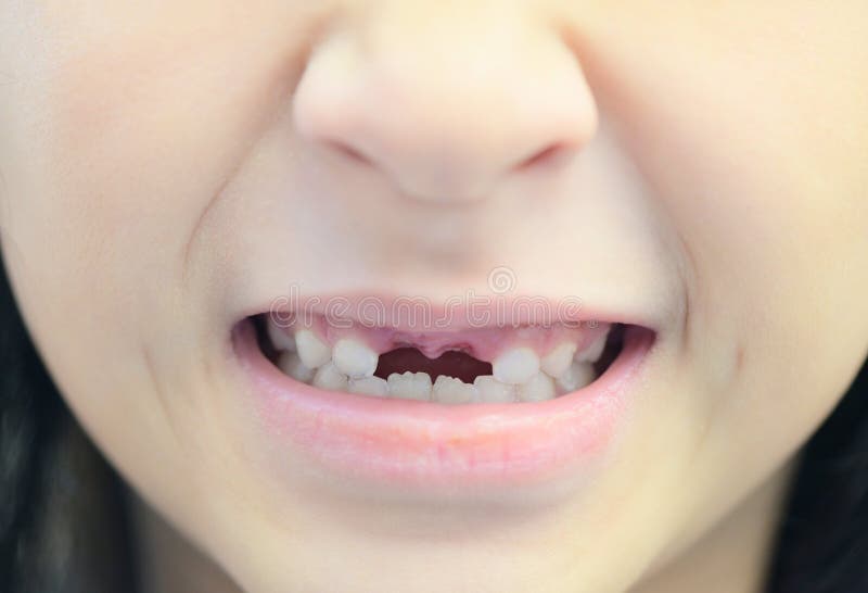 Lost Milk Teeth - Lost Baby Tooth , Smile Face of a Child Girl Baby