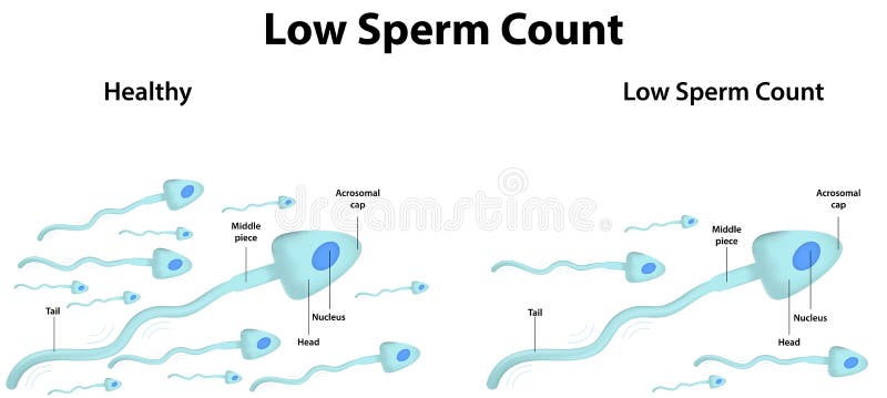 Diagram zobrazujúci nízky počet spermií.