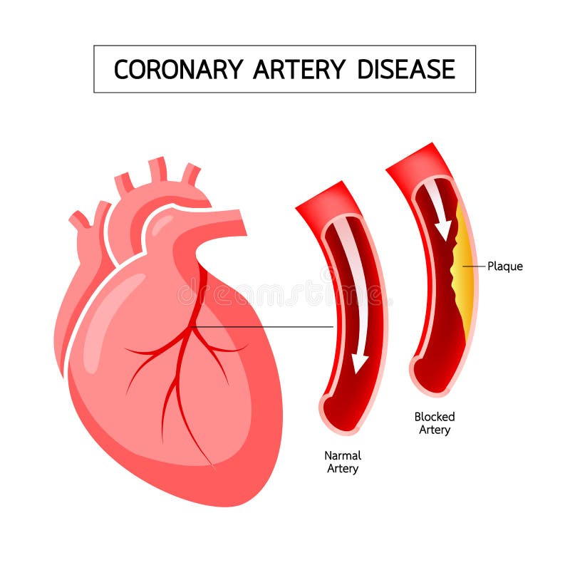 Ludzki serce z Wieńcowej arterii choroby informacji grafiką