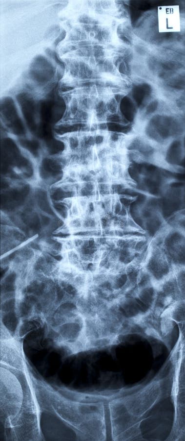 Lumbar disc herniation, lumbar spine x-ray image anterior-posterior