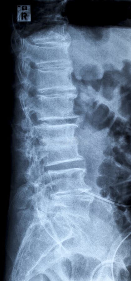 Lumbar disc herniation, lumbar spine x-ray image laterally