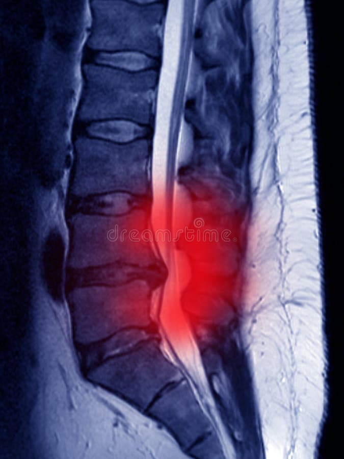 lumbar disk protrusion MRI, protrusion colored in red