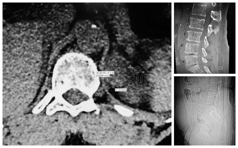 There is collage of CT computer tomography L4 - L5 level lumbosacral of vertebral column .Moderate disc extrusion ,disc material migrates distally ,severe left neuroforaminal stenosis. There is collage of CT computer tomography L4 - L5 level lumbosacral of vertebral column .Moderate disc extrusion ,disc material migrates distally ,severe left neuroforaminal stenosis.