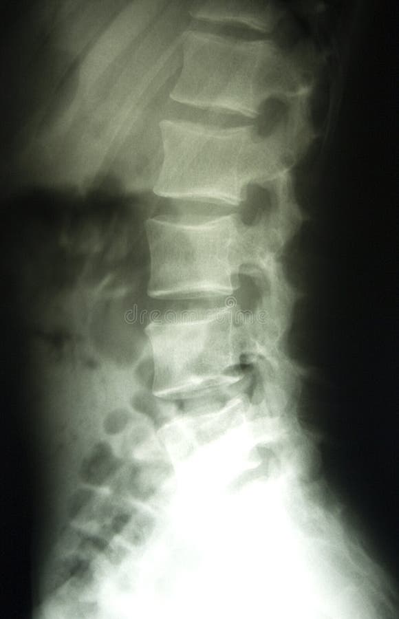 X-ray of lumbar spine, classical radiology RTG of lower back. X-ray of lumbar spine, classical radiology RTG of lower back