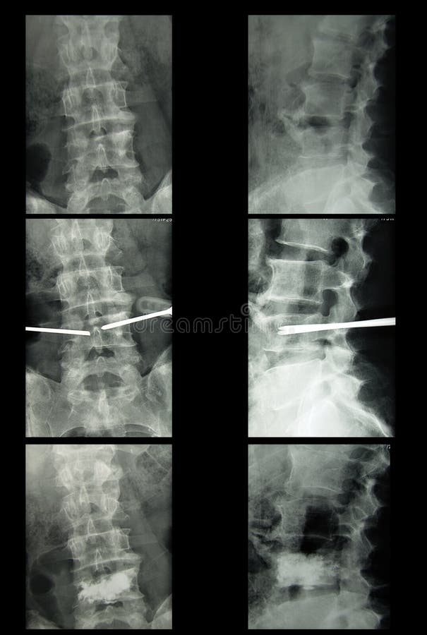 Roentgen film of lumbar spine, preparing and doing vertebroplasic procedure because of osteoporosis fractures. Roentgen film of lumbar spine, preparing and doing vertebroplasic procedure because of osteoporosis fractures