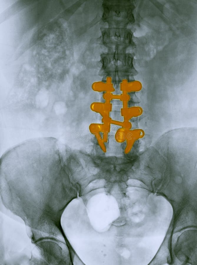 Lumbar spine x-ray showing a spinal fusion royalty free stock photo Lumbar spine x-ray showing a spinal fusion royalty free stock photo