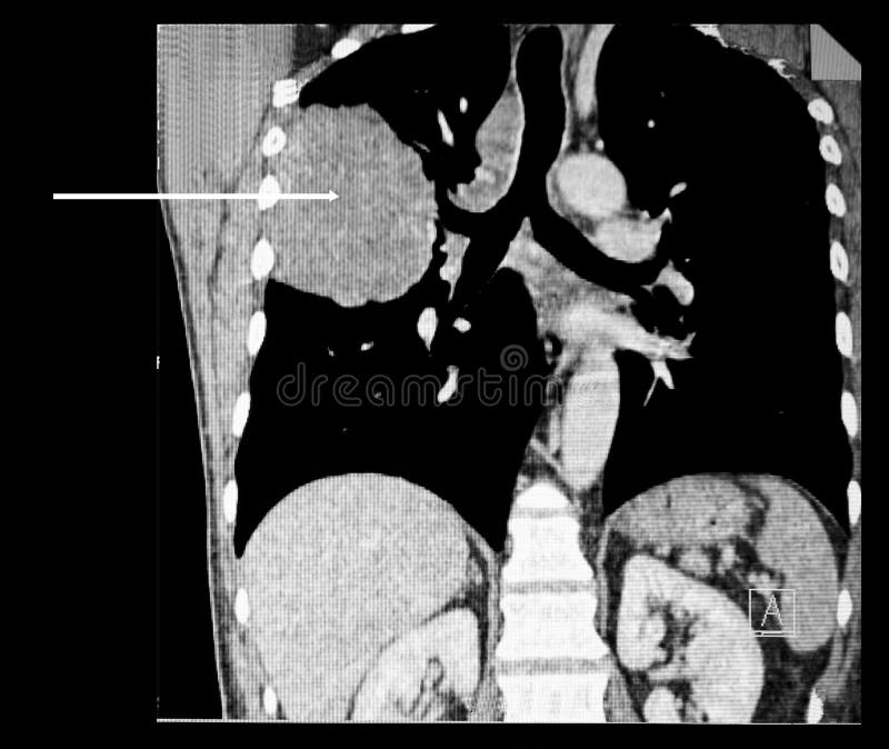 Lung cancer. Computer tomography reconstruction.