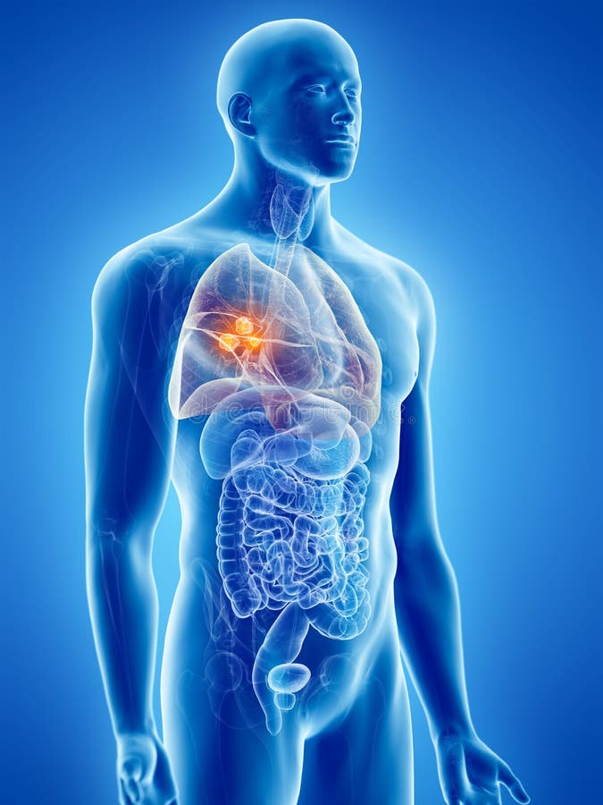 Lung cancer stock illustration. Illustration of bronchiolar - 5564055