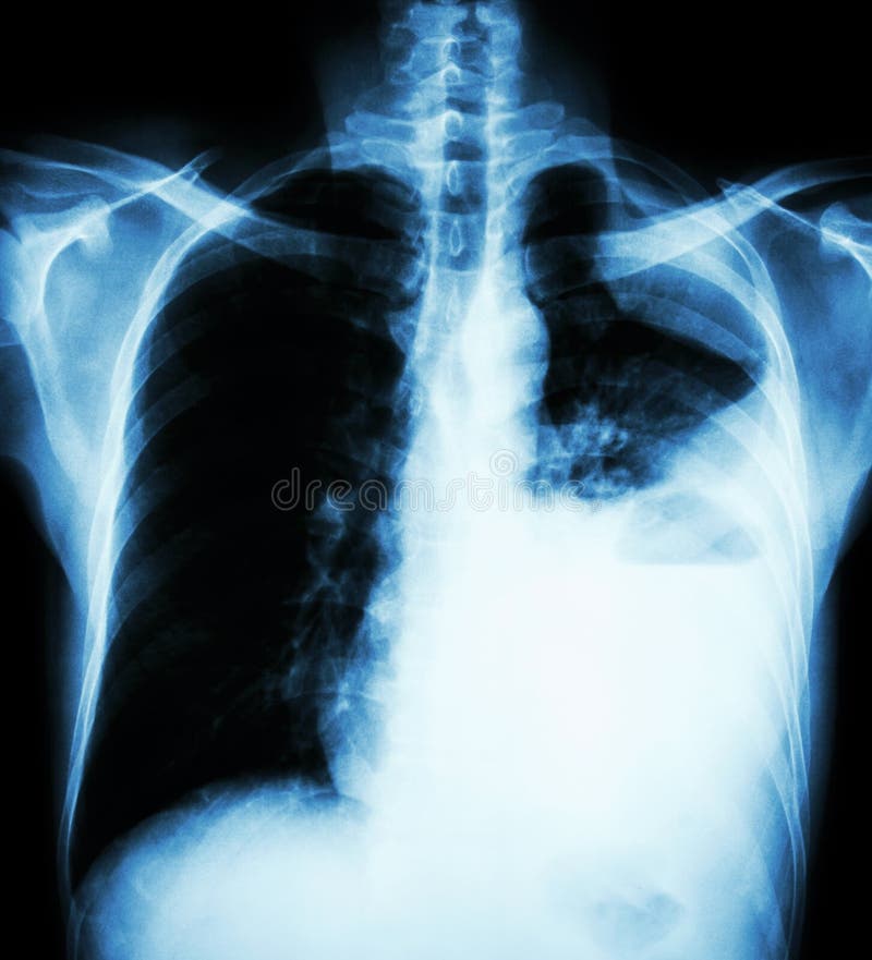 Lung cancer ( film x-ray of chest PA upright : show pleural effusion at left lung due to lung cancer ) ( 2 type of lung cancer : stock image Lung cancer ( film x-ray of chest PA upright : show pleural effusion at left lung due to lung cancer ) ( 2 type of lung cancer : stock image