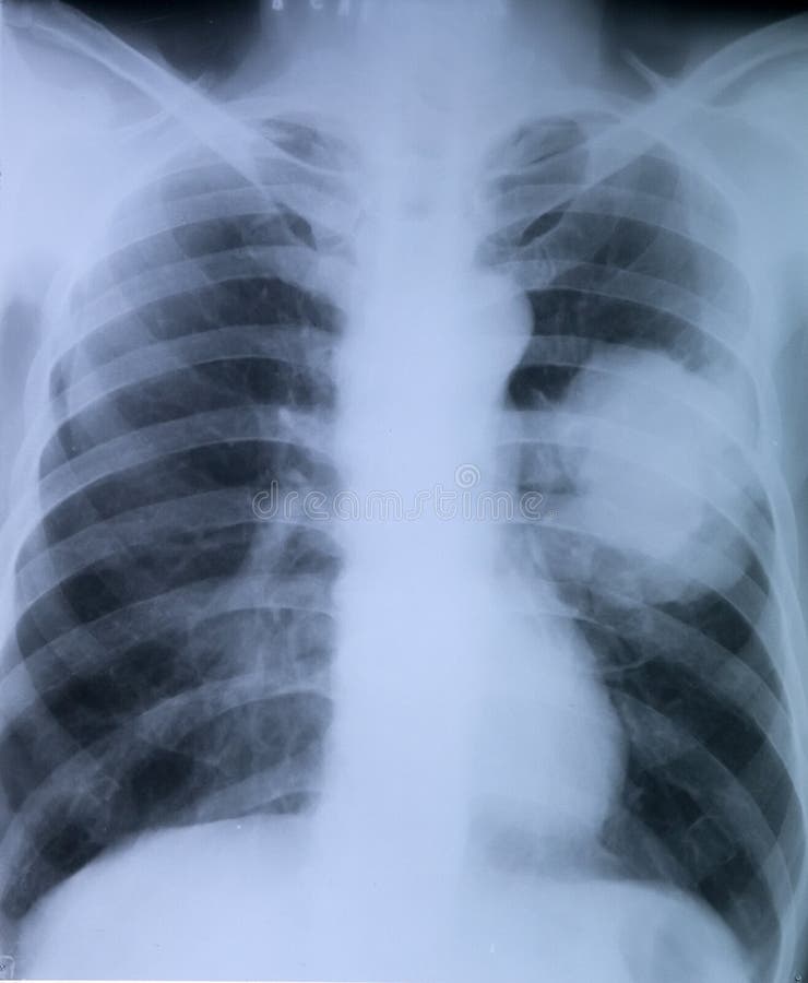 Lung cancer:X-ray image of chest
