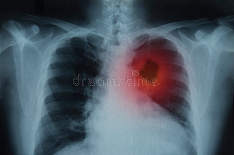 Lung cancer. X-ray image of patient lungs to lung tumor