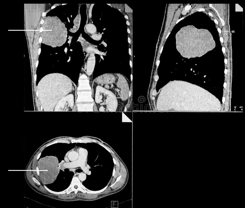Lung Cancer Rekonstruktion för beräknad tomography arkivfoton Lung Cancer Rekonstruktion för beräknad tomography arkivfoton