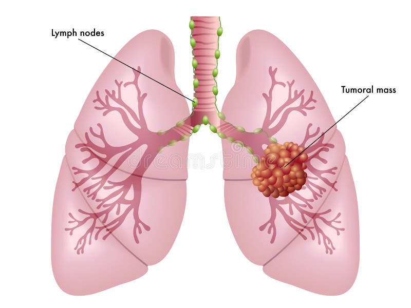 Médico ilustraciones de síntomas de pulmones cáncer.