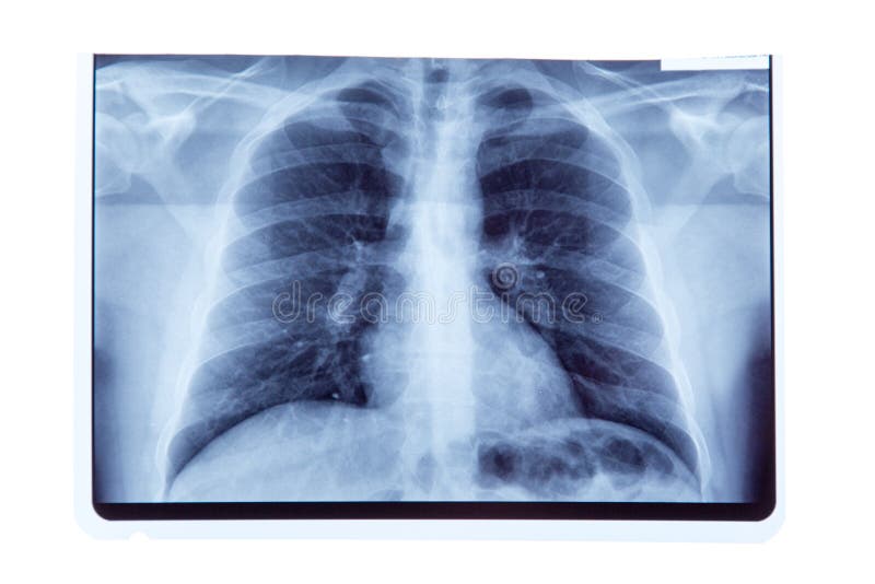 Lung radiography x-ray result