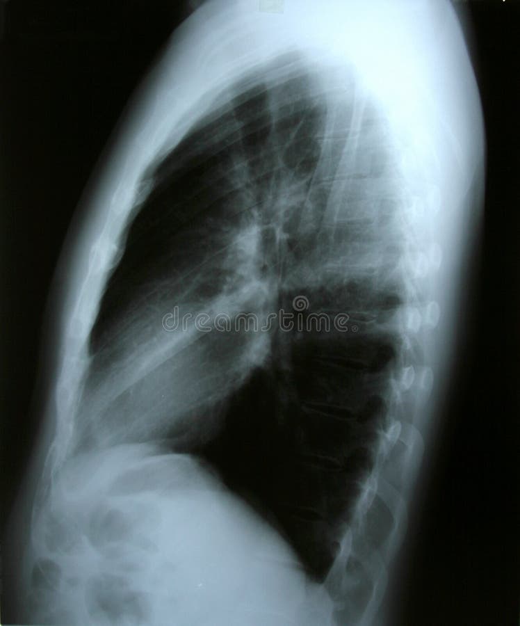 Lung x-ray