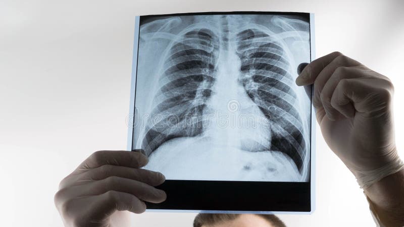 Lungavfall på vit bakgrund hos en läkare i händerna på en röntgenlunga.