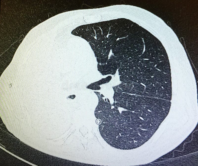 Lungcancer för pneumonectomy för Ct-bildläsning föregående höger royaltyfri bild Lungcancer för pneumonectomy för Ct-bildläsning föregående höger royaltyfri bild