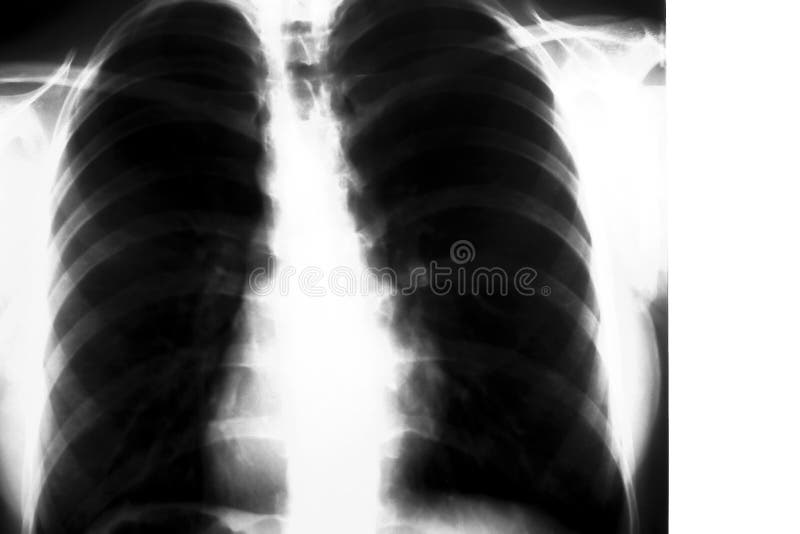 Lunge-Röntgenstrahl