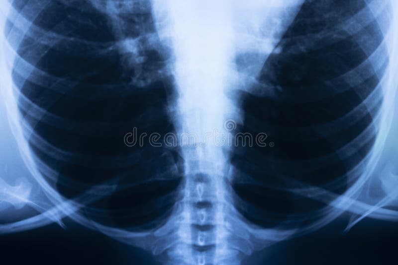 Lungs ribs xray scan stock photo. Image of cancer, medicine 221004904