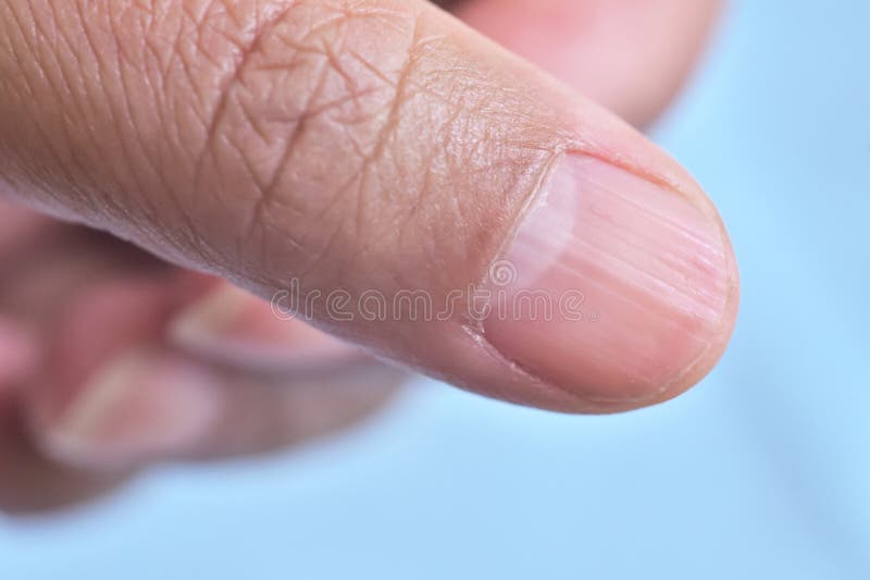 lunula longitudinal ridging nail thumb vertical nail ridges lunula longitudinal ridging nail thumb vertical nail 281822661