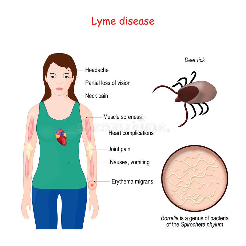 Lyme Disease Auf Deutsch Captions Pages