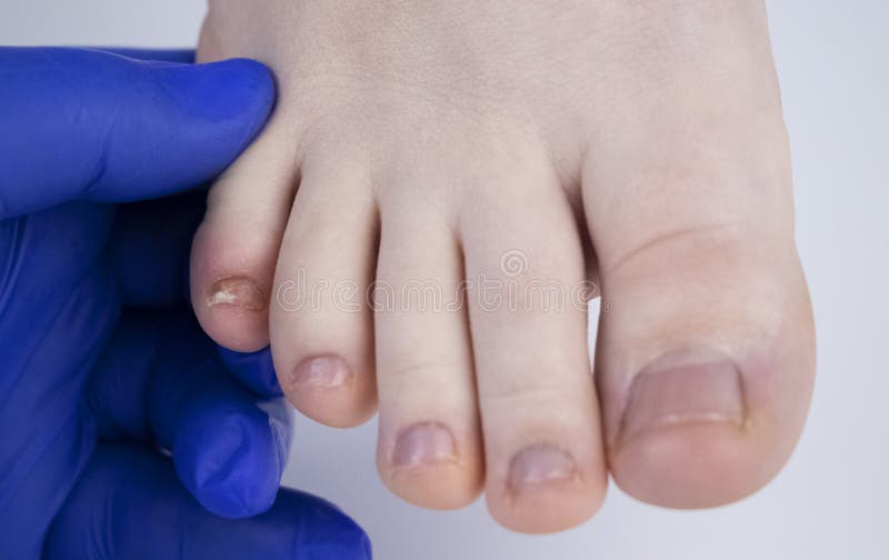 Läkare som podolog undersöker nagelsvampen på kvinnans fot. behandling av onychomykosmykos. deformerad nagelplatta arkivbild