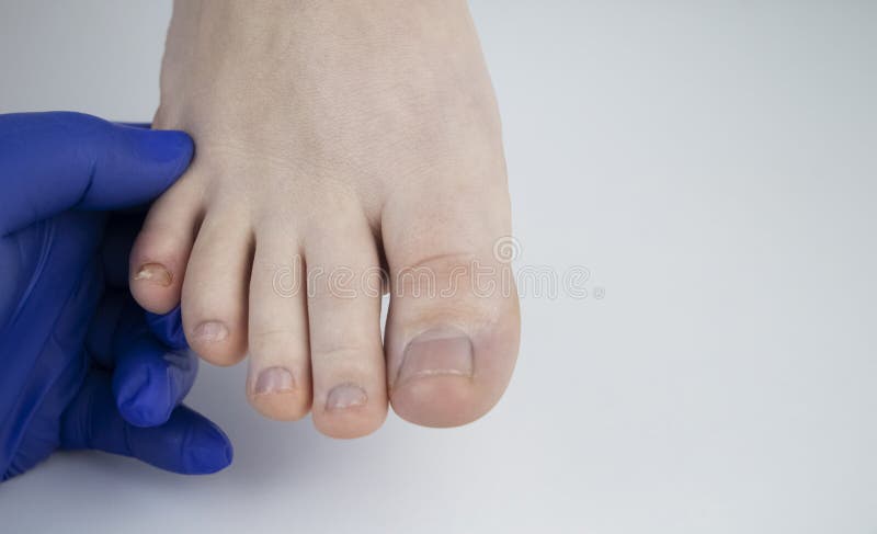 Läkare som podolog undersöker nagelsvampen på kvinnans fot. behandling av onychomykosmykos. deformerad nagelplatta royaltyfri fotografi