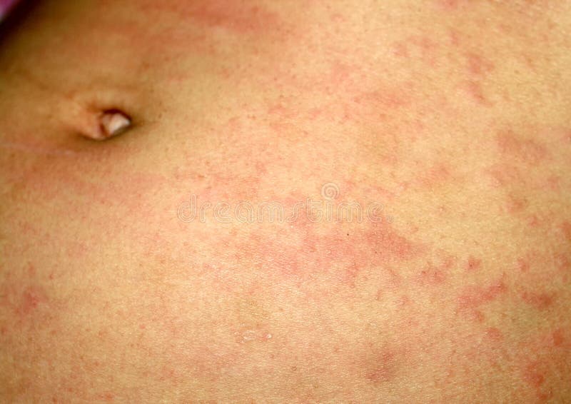 Líquene cor-de-rosa na pele do abdômen Psoríase, dermatite, eczema, urticaria, alergias imagens de stock royalty free Líquene cor-de-rosa na pele do abdômen Psoríase, dermatite, eczema, urticaria, alergias imagens de stock royalty free