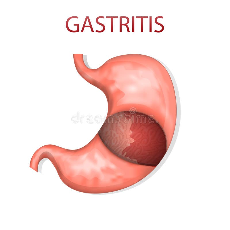 Icd gastritis