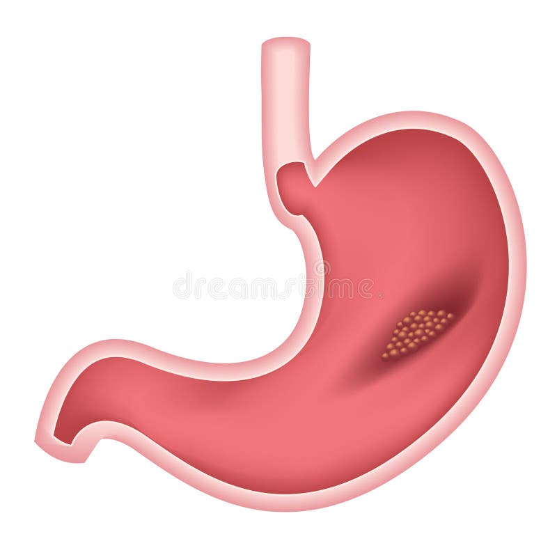 Maagkanker. Maagtumor in het spijsverteringsstelsel? royalty-vrije illustratie