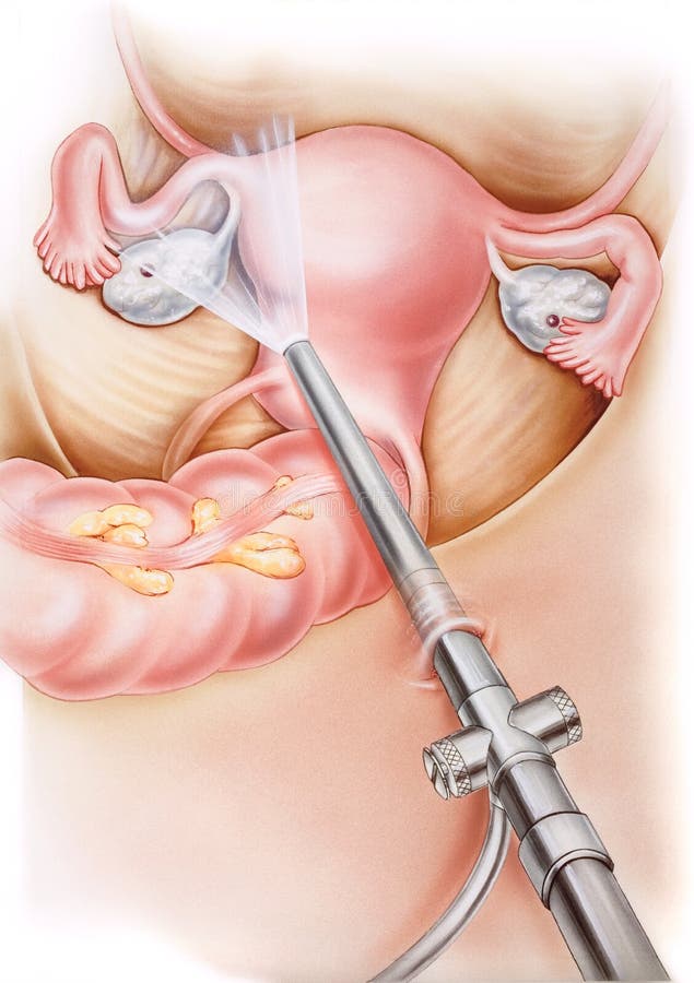 Macica - Laparoscopy ilustracji Macica - Laparoscopy ilustracji