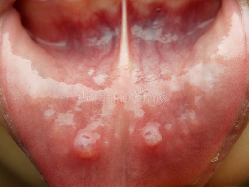 Macro colpo della malattia di aphtha di un bambino o di un bambino immagine stock