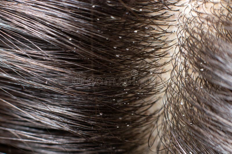 375 Scalp Fungus Stock Photos - Free & Royalty-Free Stock Photos from Dreamstime 375 Scalp Fungus Stock Photos - Free & Royalty-Free Stock Photos from Dreamstime