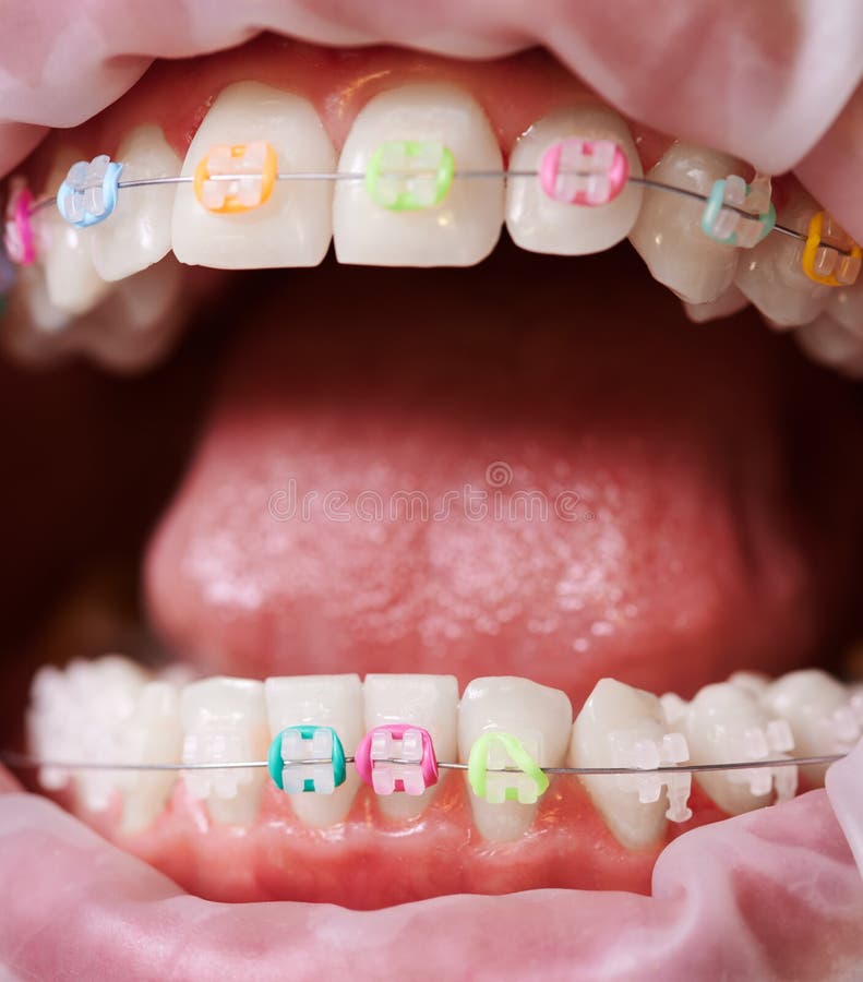 Learning the Basics About Rubber Bands on Braces