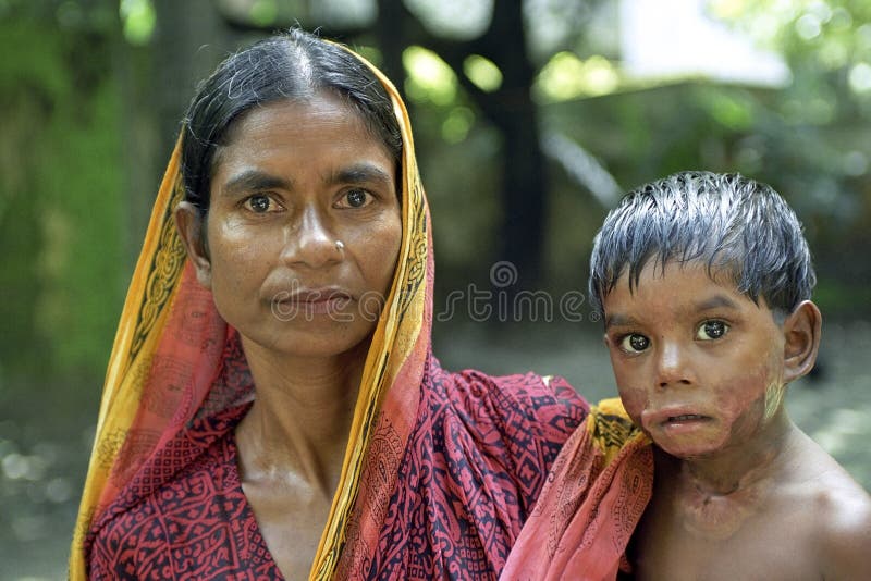 Madre y niño con las quemaduras, Dacca del retrato de la familia imágenes de archivo libres de regalías Madre y niño con las quemaduras, Dacca del retrato de la familia imágenes de archivo libres de regalías