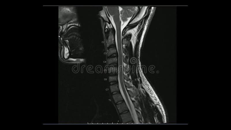 Magnetic Resonance Images Of Cervical Spine Sagittal T2 Weighted Images