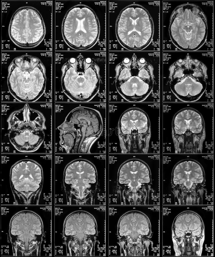 resonance imaging stock photo. Image of brain 44746734