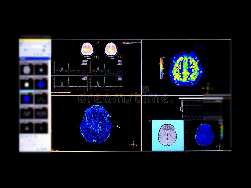 Magnetic Resonance MR spectroscopy of the brain .