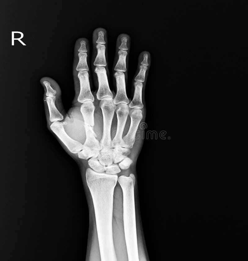 Скелет руки рентген. Мягкие ткани и кости ладони. Рентген ара-1. То рентгена руки. Main ap