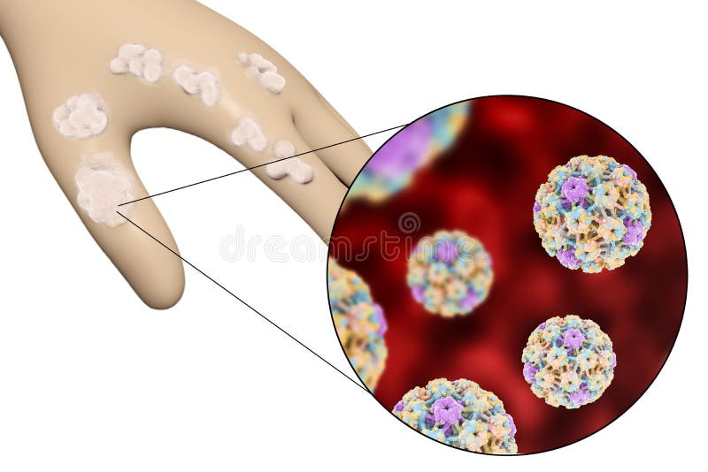 Main Avec Les Verrues Et Le Papillomavirus Illustration Stock