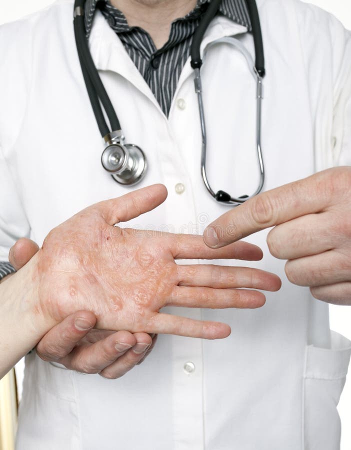 Main De Examen De Dermatologue Avec L'eczema Grave Image stock Image