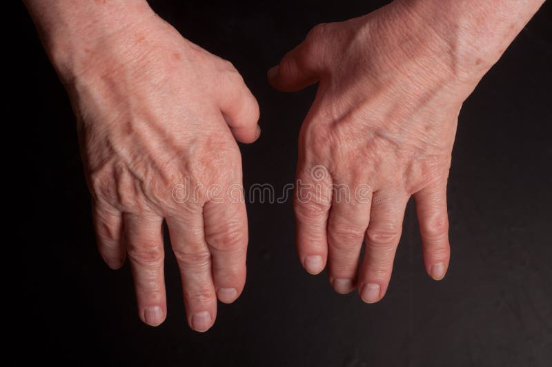 Mains supérieures. Souffrance de la douleur et du rhumatisme photographie stock libre de droits Mains supérieures. Souffrance de la douleur et du rhumatisme photographie stock libre de droits