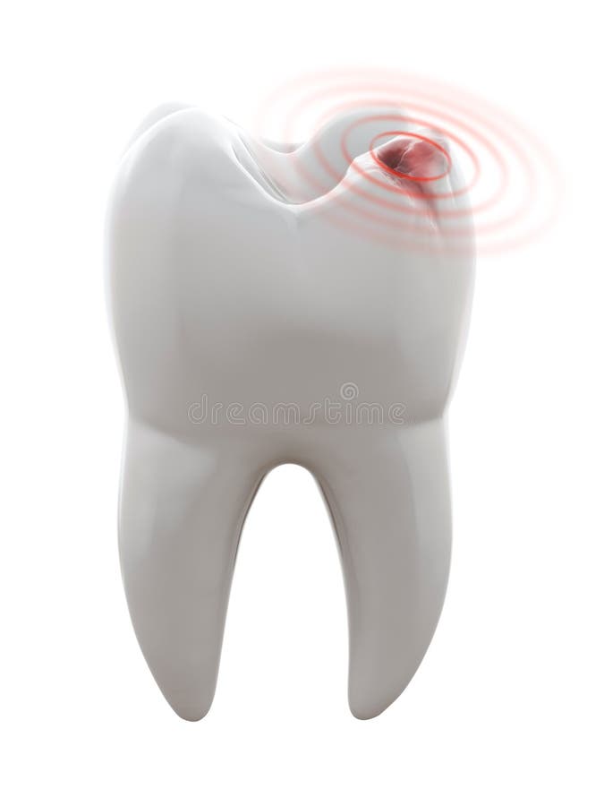 3D illustration of tooth with cavity - Toothache. 3D illustration of tooth with cavity - Toothache