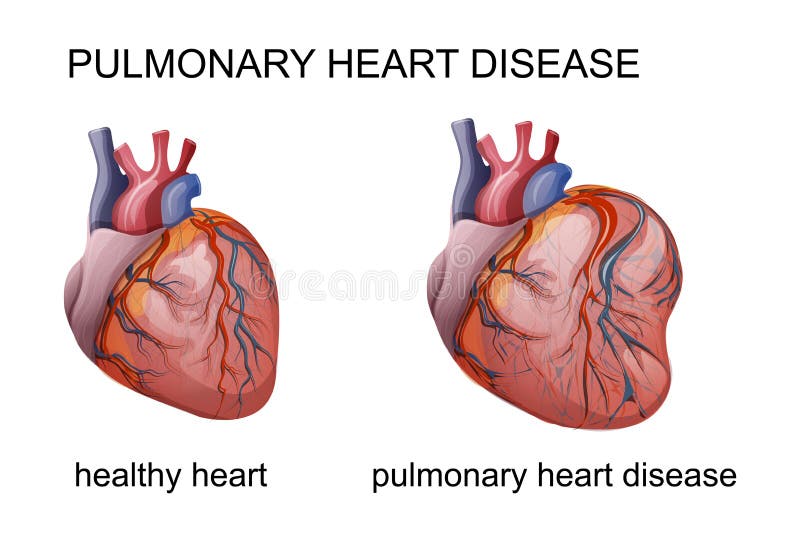 Maladie cardiaque pulmonaire illustration de vecteur Maladie cardiaque pulmonaire illustration de vecteur