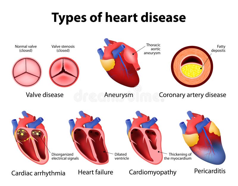 Malattia cardiaca
