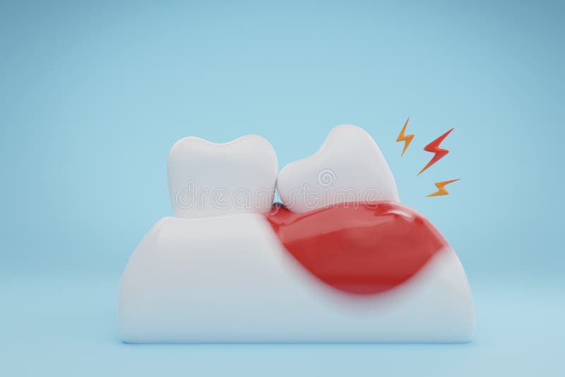 Gums and teeth disease wisdom tooth infection on blue background. 3D rendering. Gums and teeth disease wisdom tooth infection on blue background. 3D rendering.