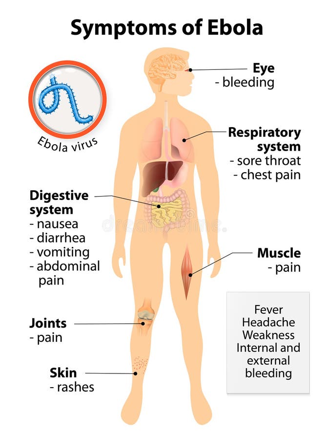 Malattia di virus di Ebola illustrazione di stock Malattia di virus di Ebola illustrazione di stock